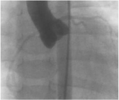 Case Report: Structural Changes in the Coronary Vessel Wall in a Patient With Incomplete Kawasaki Disease